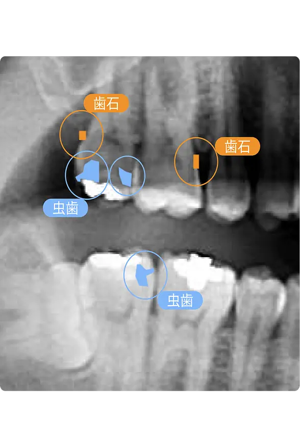 虫歯や歯石の位置を示した歯のレントゲン画像